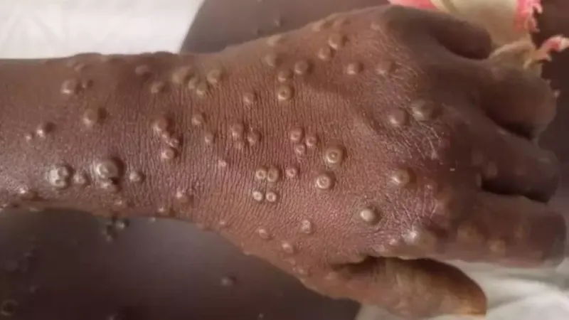 Ghana’s Ongoing Battle with Mpox: 18 New Cases Recorded