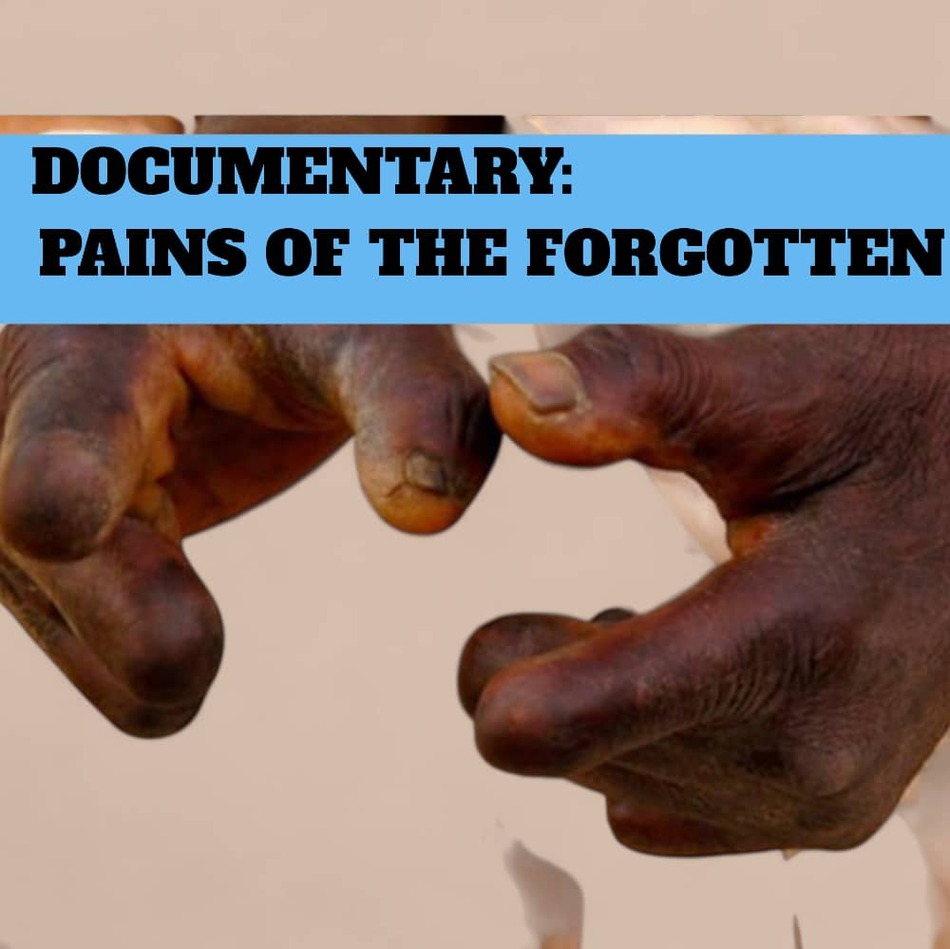 Pains of the Forgotten: Leprosy, Stigma, and Resilience in Ghana–VIDEO ATTACHED
