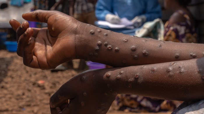 WHO Sounds Alarm: Western Region at the Epicenter of Ghana’s Mpox Battle